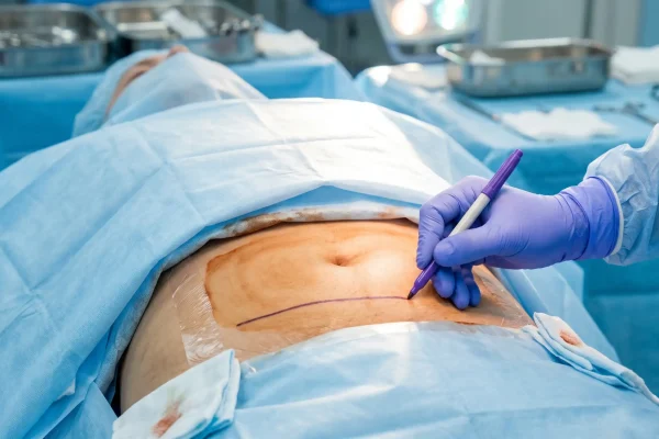 Surgeon marking the low incision line for a tummy tuck scar