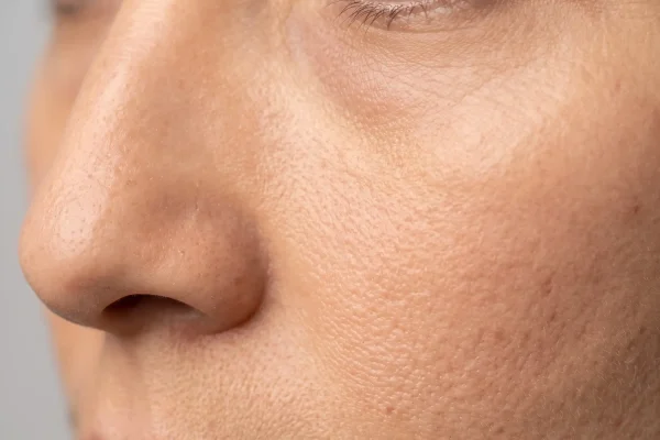 Mild under-eye PRP swelling in the lower eyelid one day after treatment