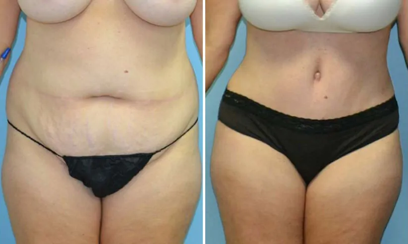 tummy tuck before (left) and after (right)