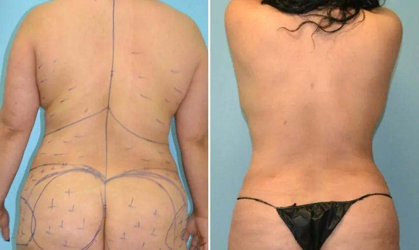 female liposuction before (left) and after (right), back view