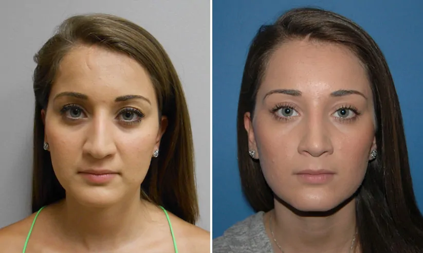 Female rhinoplasty before (left) and after (right), front view