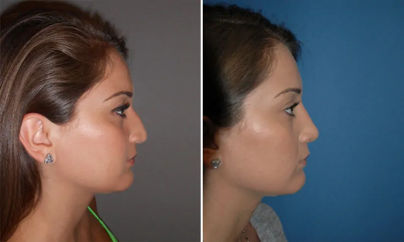 Female rhinoplasty before (left) and after (right), side view