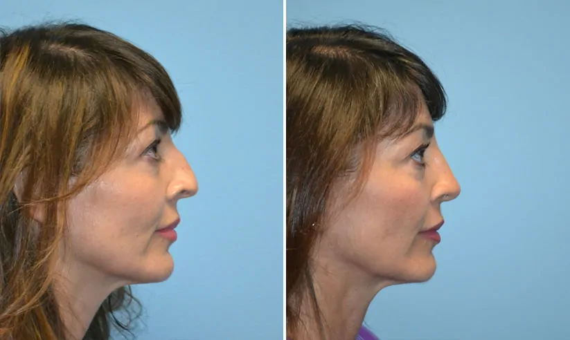 Female rhinoplasty before (left) and after (right), side view