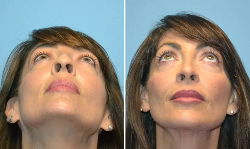 Male rhinoplasty before (left) and after (right), front view
