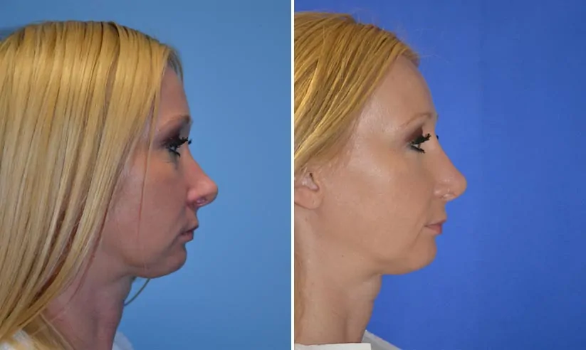 Female rhinoplasty before (left) and after (right), side view