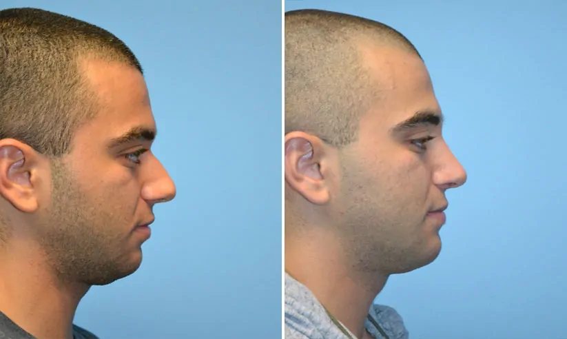 Male rhinoplasty before (left) and after (right), side view