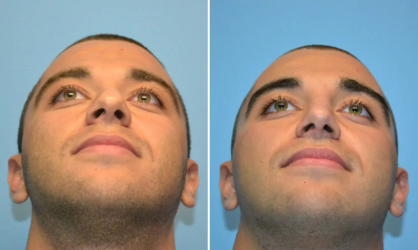Male rhinoplasty before (left) and after (right)