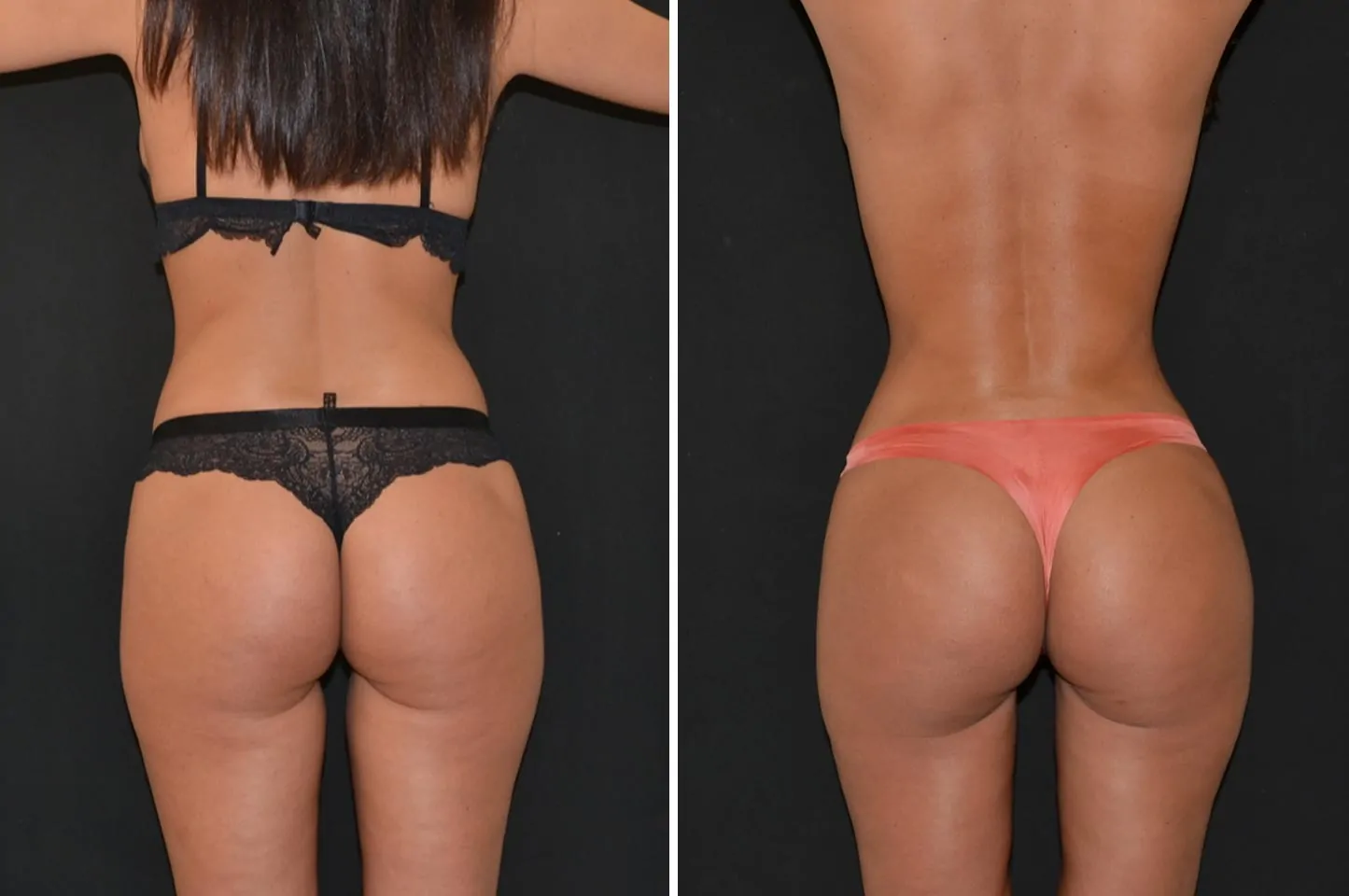 Female power assisted liposuction before (left) and after (right), back view