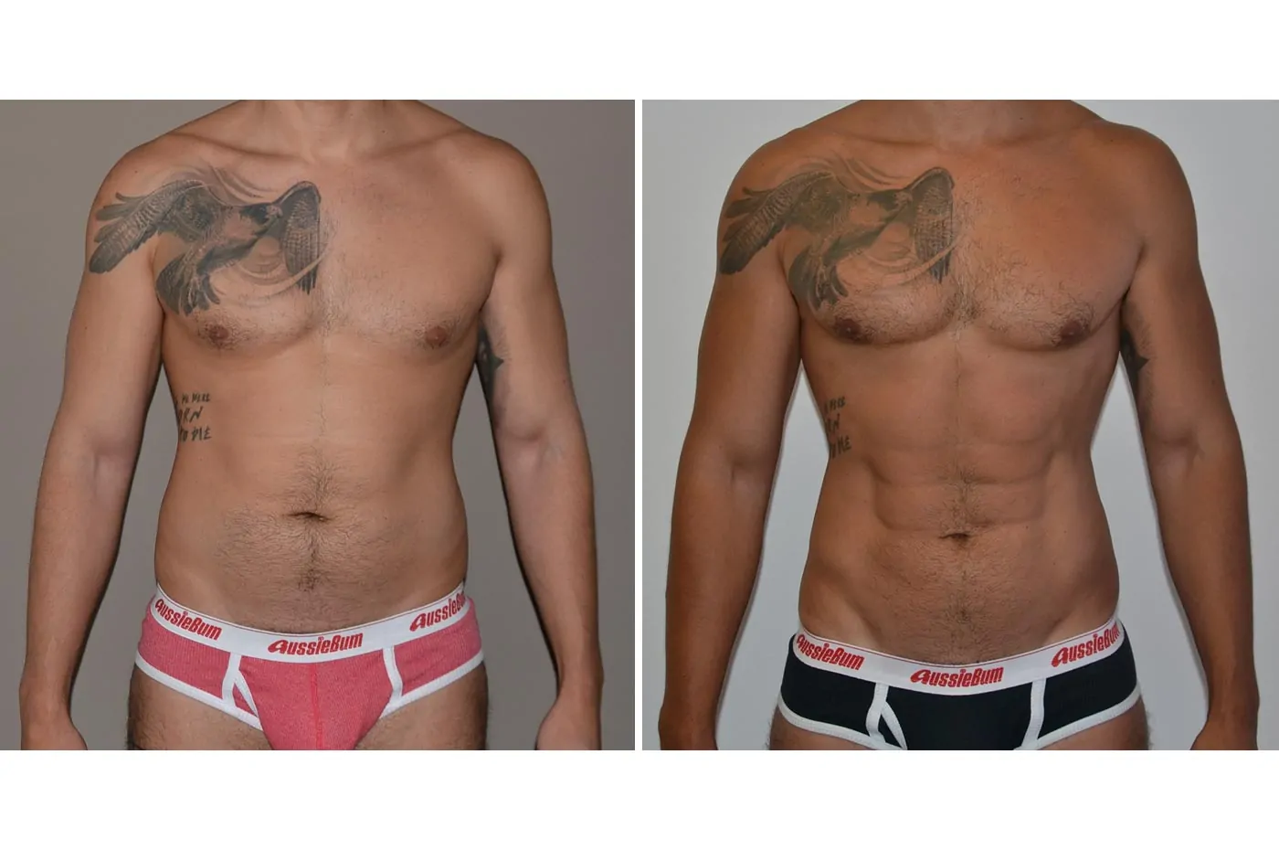 Male high definition liposuction before (left) and after (right), front view