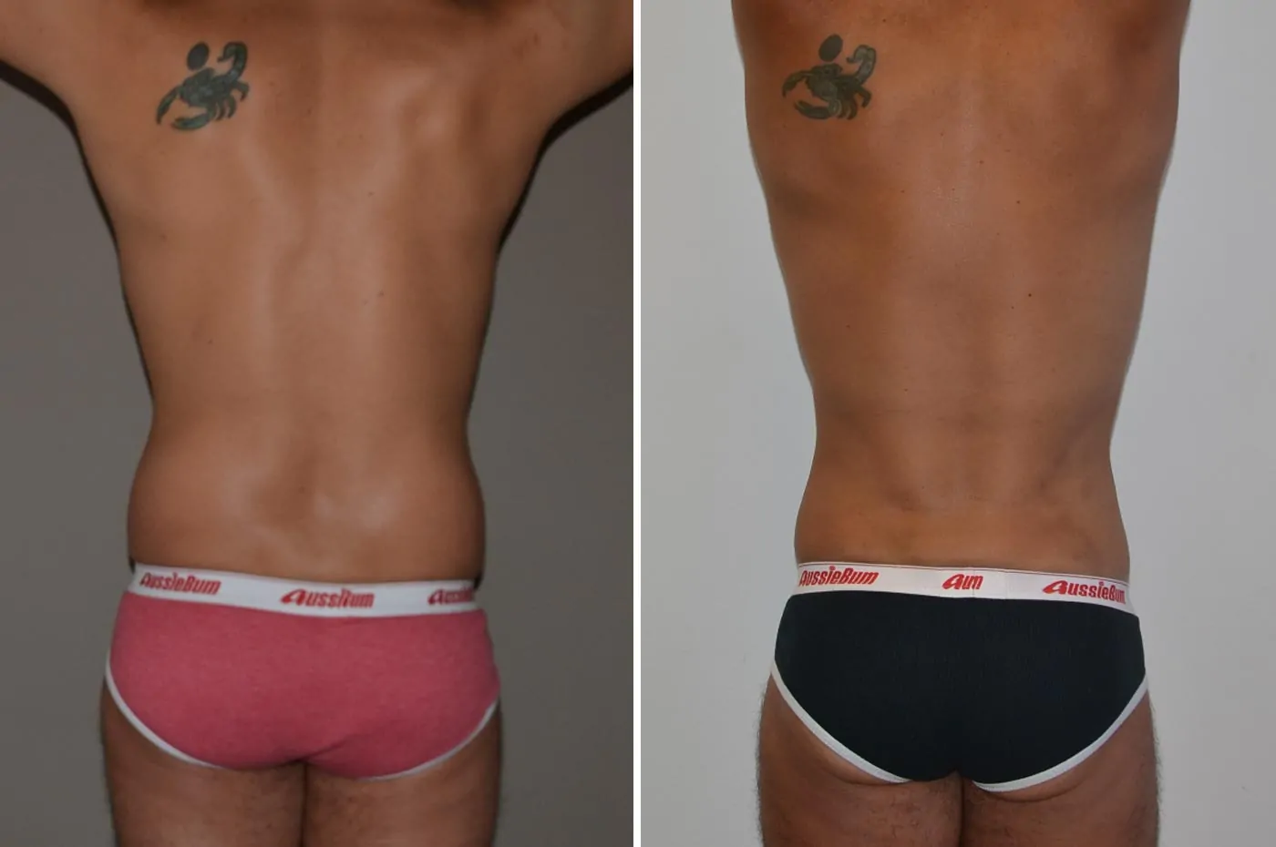 Male high definition liposuction before (left) and after (right), back view