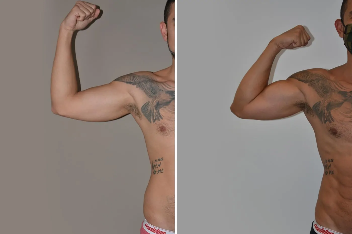 Male high definition liposuction before (left) and after (right), arm with tattoos