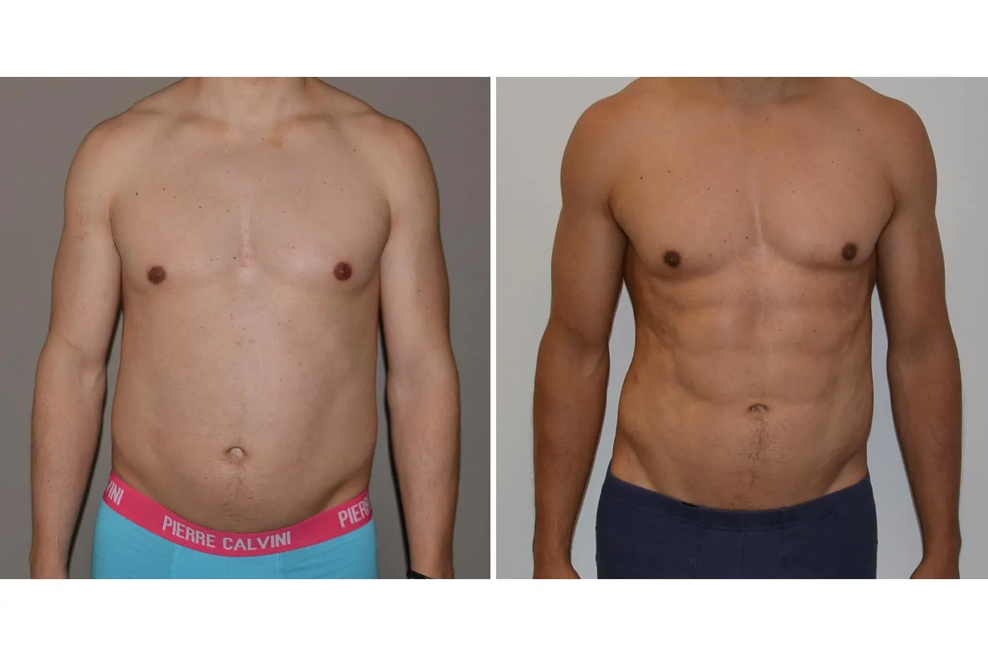 Male high definition liposuction before (left) and after (right), front view