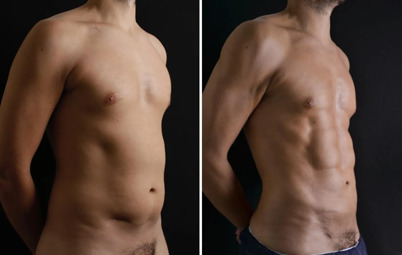 Male high definition liposuction before (left) and after (right), side view