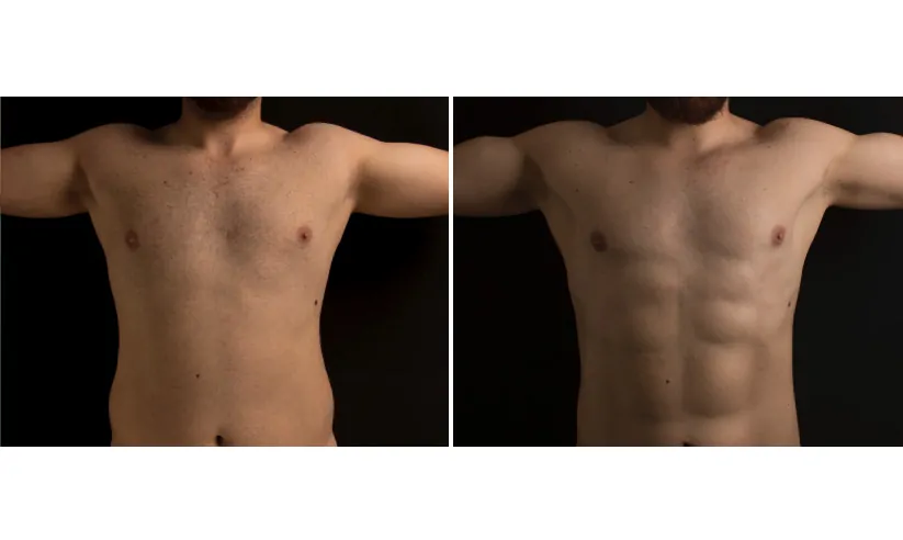 Male high definition liposuction before (left) and after (right), front view, arms extended