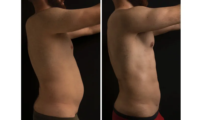 Male high definition liposuction before (left) and after (right), side view