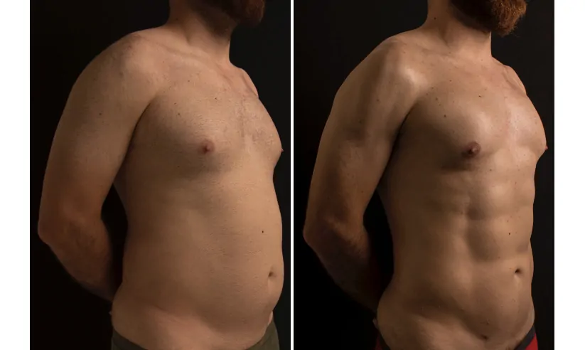 Male high definition liposuction before (left) and after (right), side view