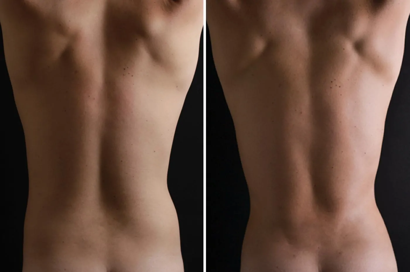 Male high definition liposuction before (left) and after (right), back view