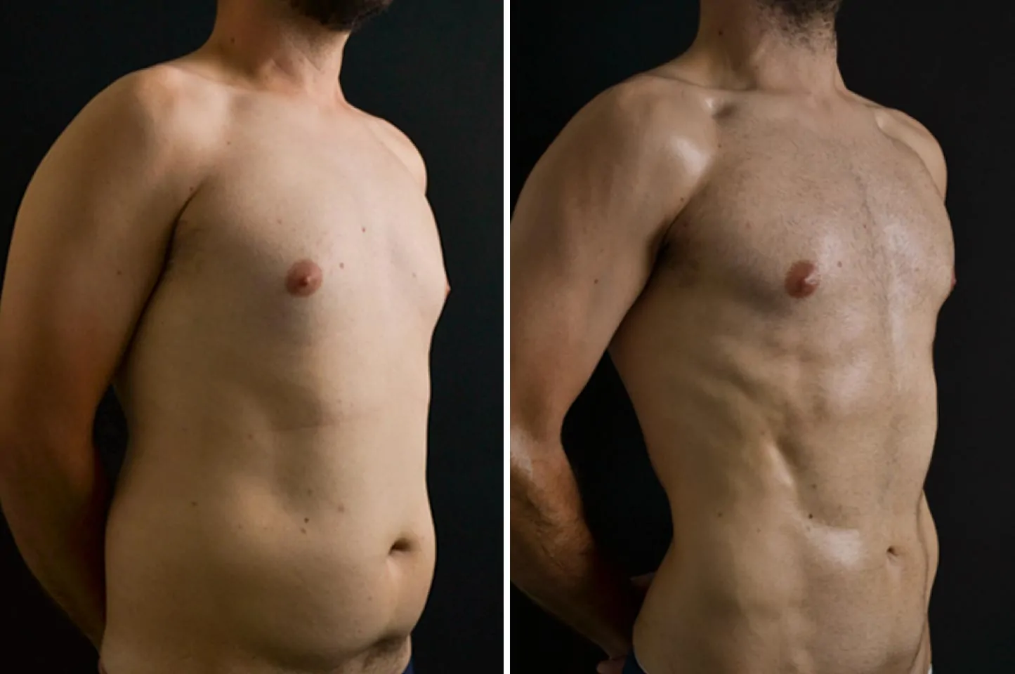 Male high definition liposuction before (left) and after (right), side view