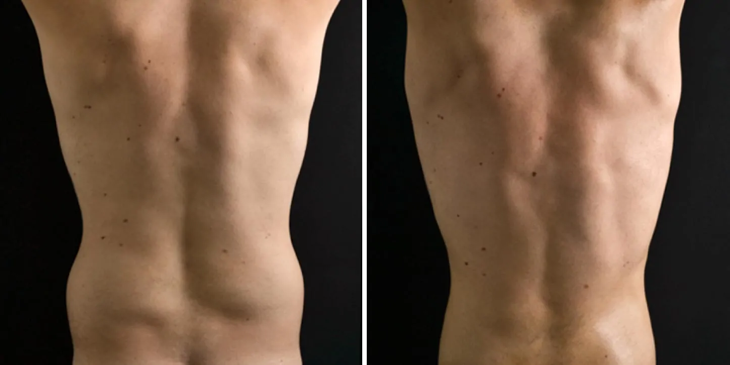 Male high definition liposuction before (left) and after (right), back view