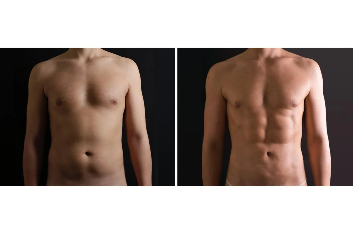 Male high definition liposuction before (left) and after (right), front view