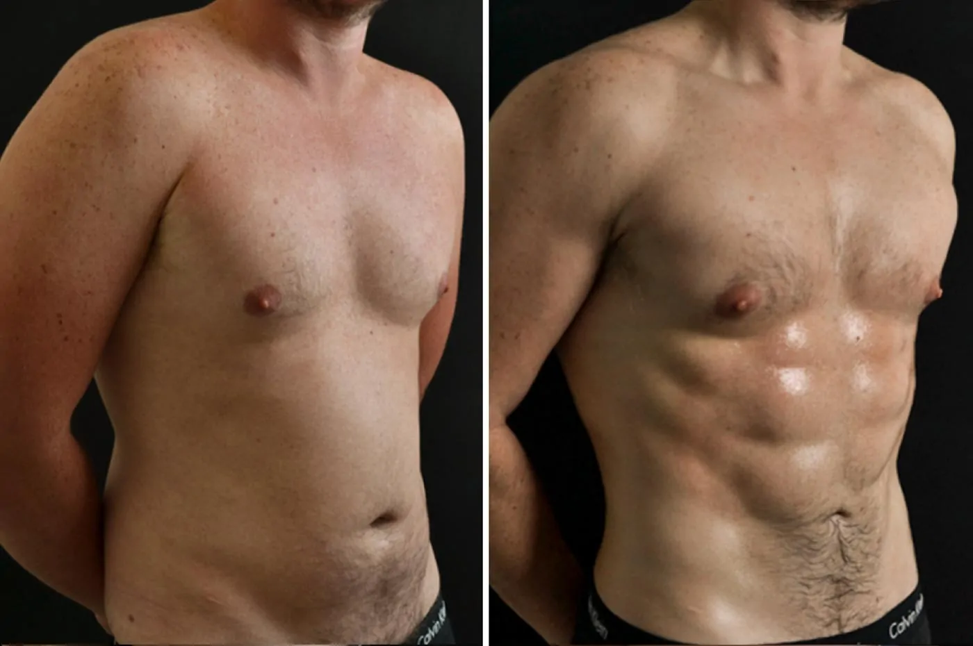 Male high definition liposuction before (left) and after (right), front view, close up of chest