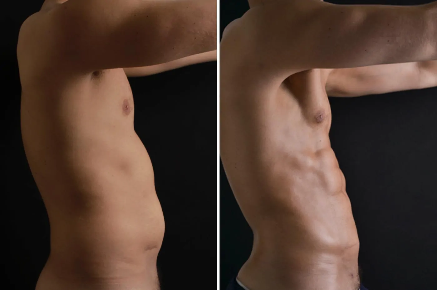 Male high definition liposuction before (left) and after (right), side view