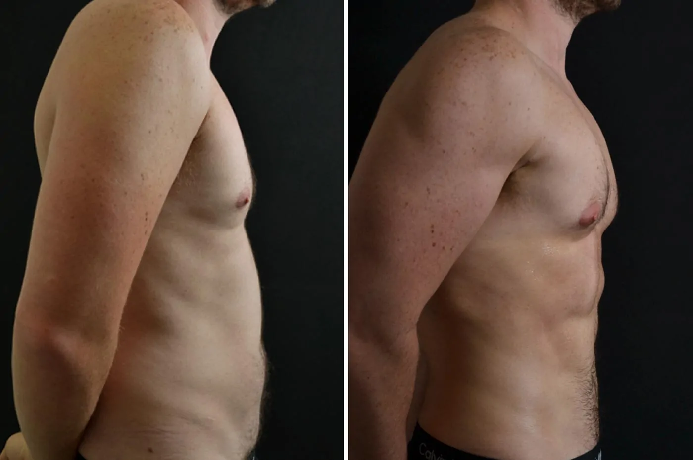 Male high definition liposuction before (left) and after (right), side view