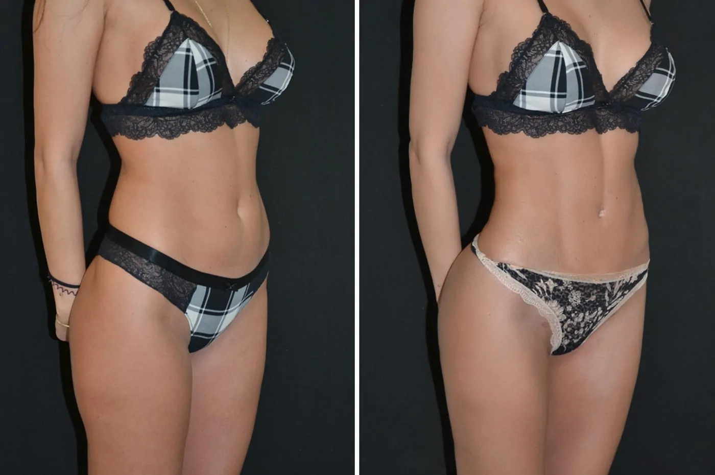 Female power assisted liposuction before (left) and after (right), front view