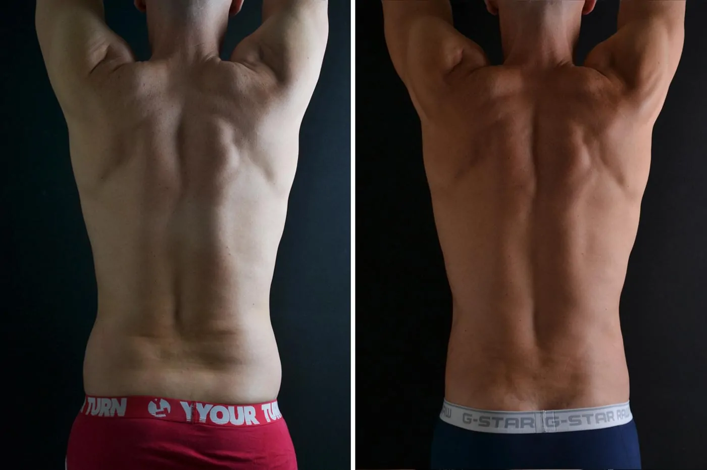 Male high definition liposuction before (left) and after (right), back view