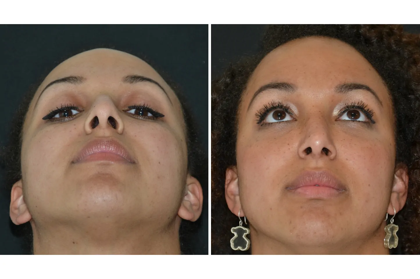 Female rhinoplasty before (left) and after (right), front view, nostrils