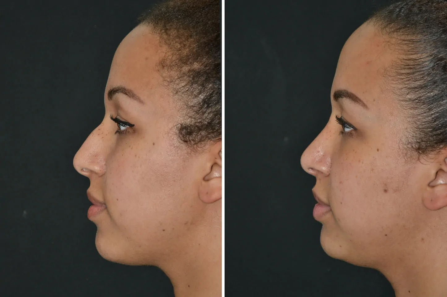 Female rhinoplasty before (left) and after (right), side views