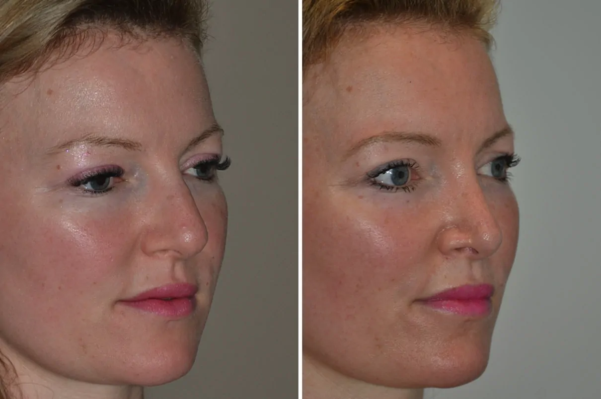 Female rhinoplasty before (left) and after (right), side view