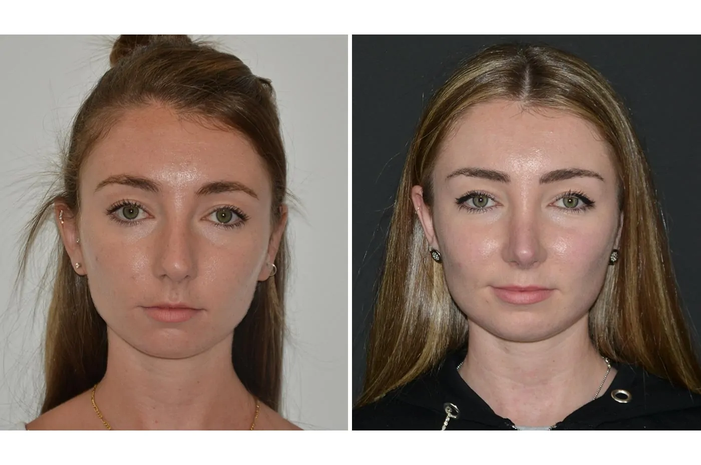 Female rhinoplasty before (left) and after (right), front view