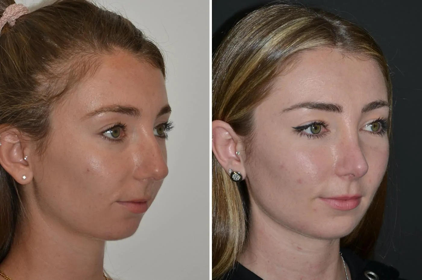 Female rhinoplasty before (left) and after (right), front view