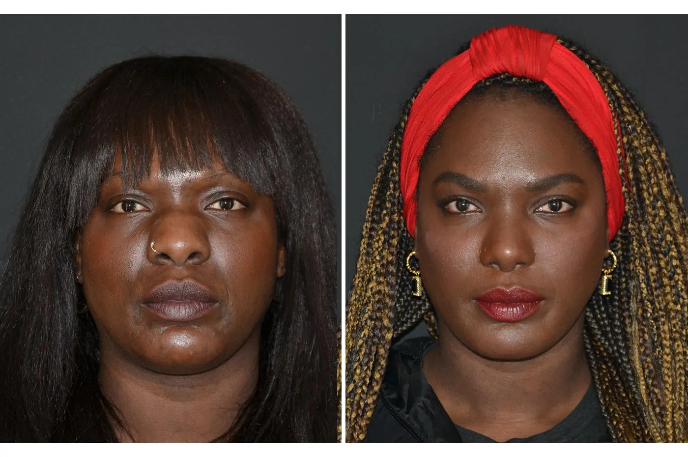 Female rhinoplasty before (left) and after (right), front view