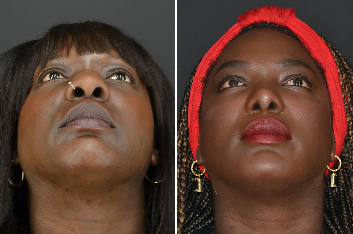 Female rhinoplasty before (left) and after (right), front view, nostrils