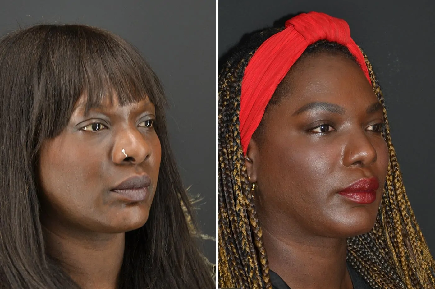 Female rhinoplasty before (left) and after (right), side view