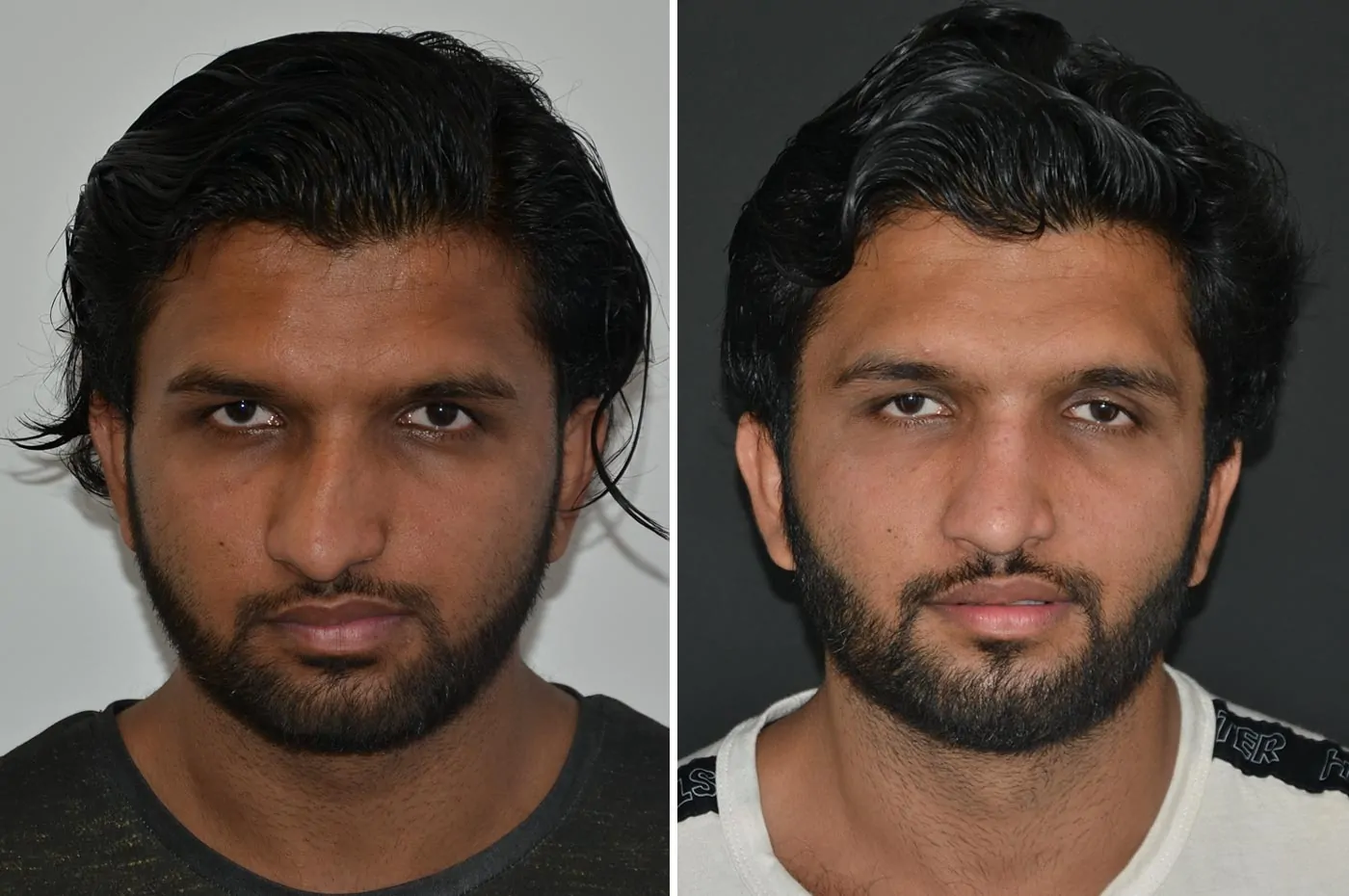 Male rhinoplasty before (left) and after (right), front view
