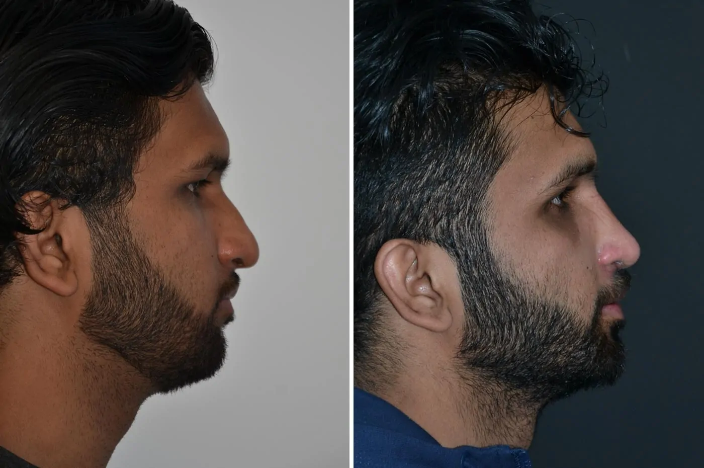 Male rhinoplasty before (left) and after (right), side view