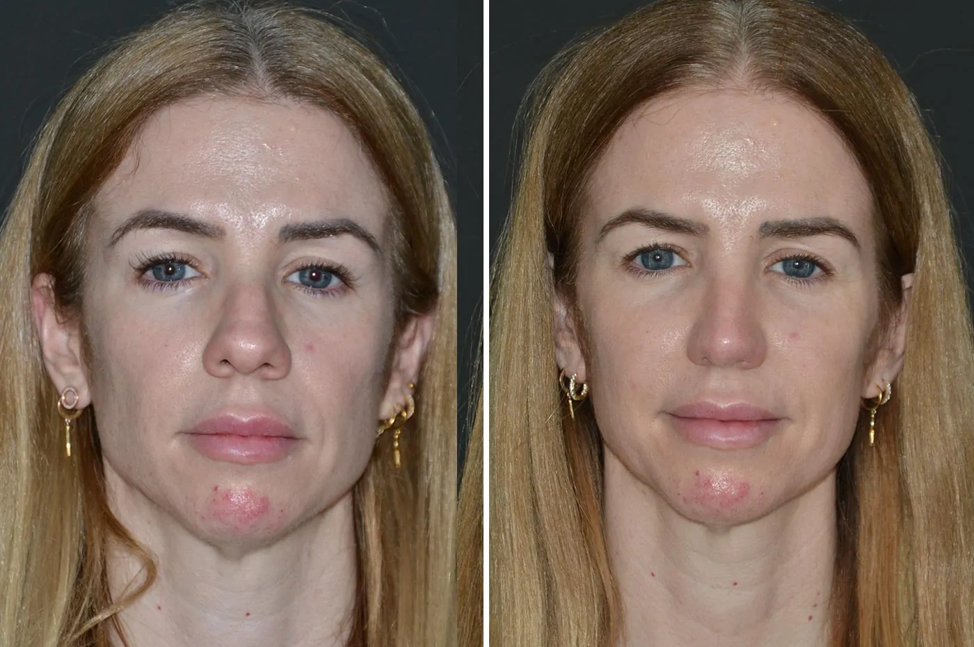 Female rhinoplasty before (left) and after (right), front view