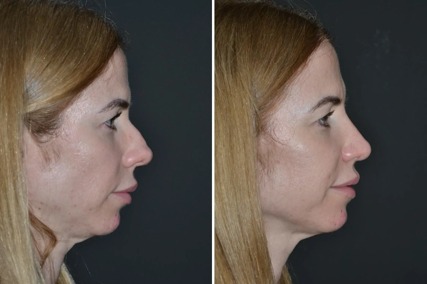 Female rhinoplasty before (left) and after (right), side view