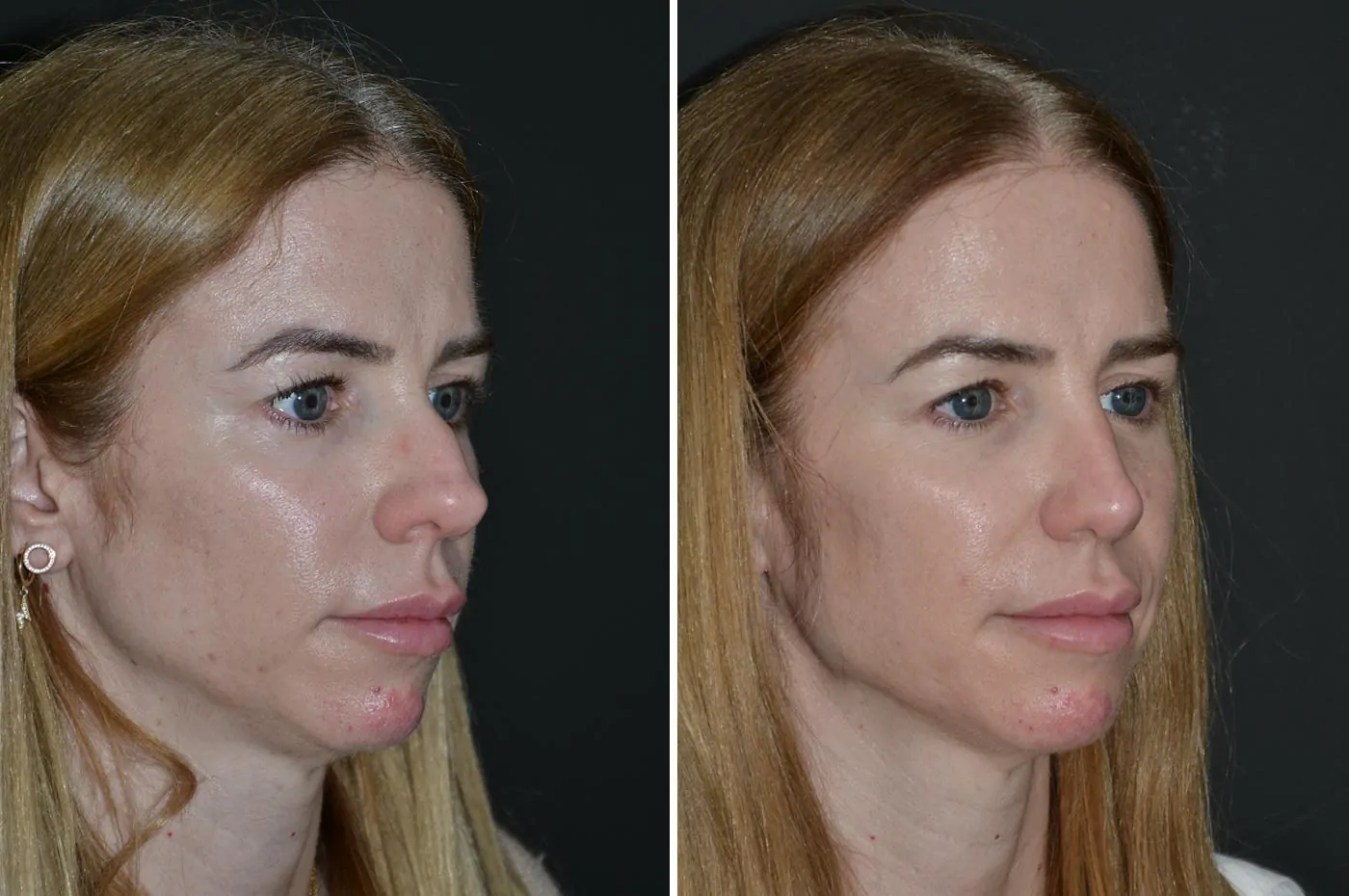 Female rhinoplasty before (left) and after (right), side view