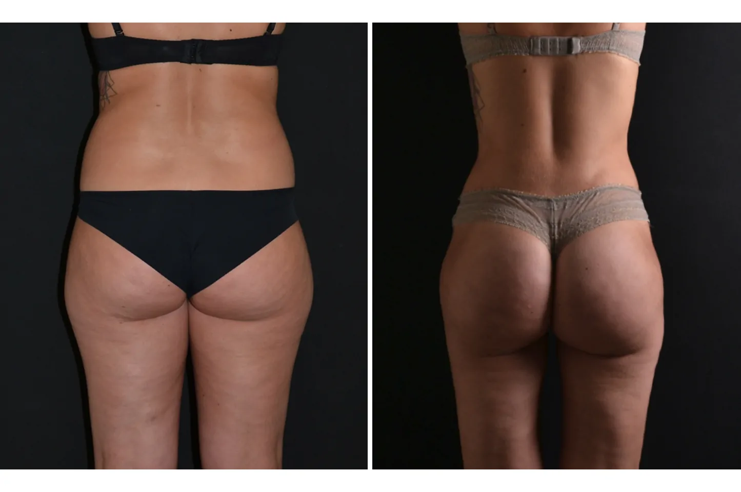 Female power assisted liposuction before (left) and after (right), back view