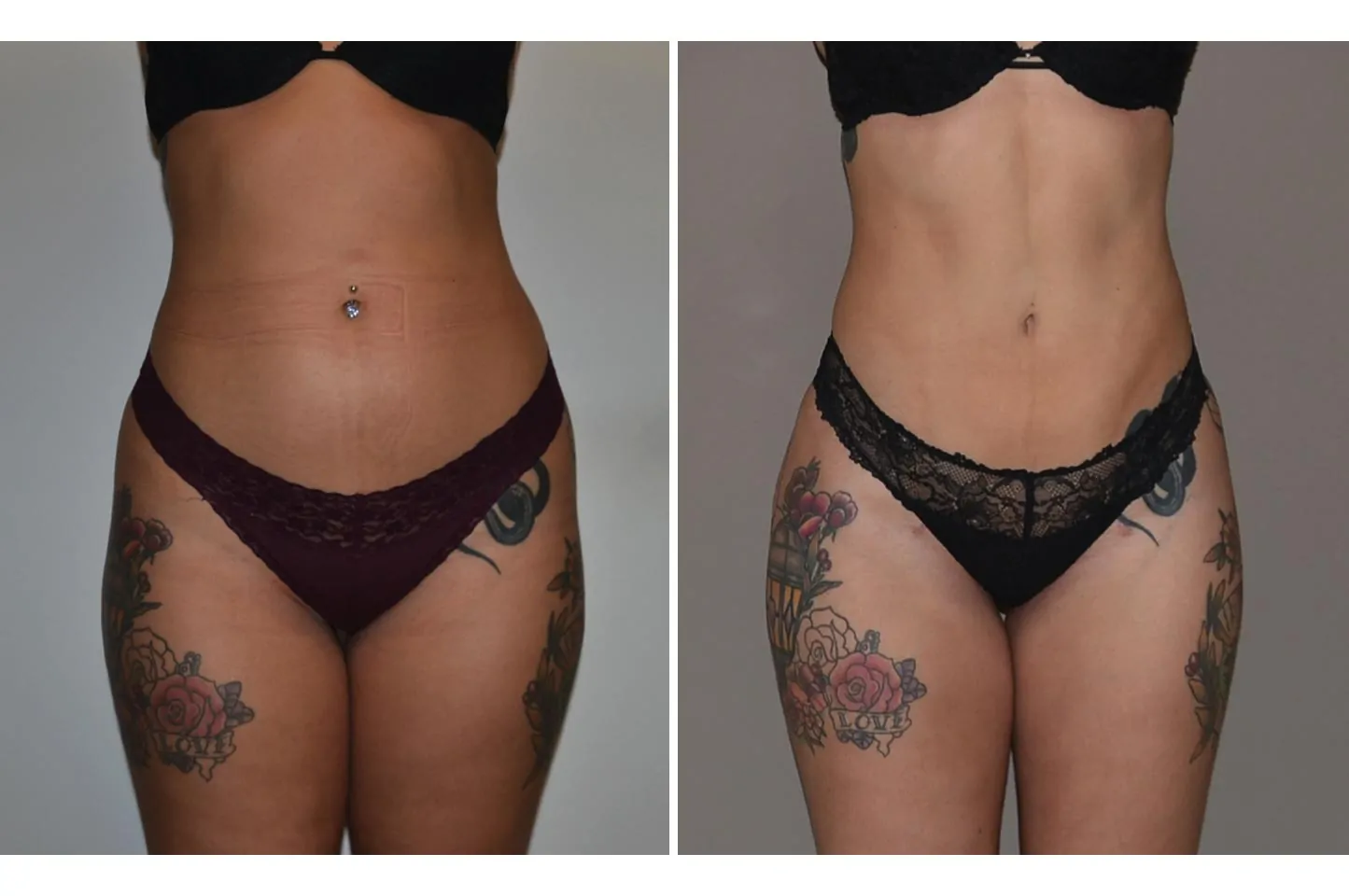 Female power assisted liposuction before (left) and after (right), front view