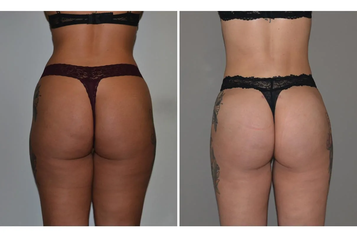 Female power assisted liposuction before (left) and after (right), back view