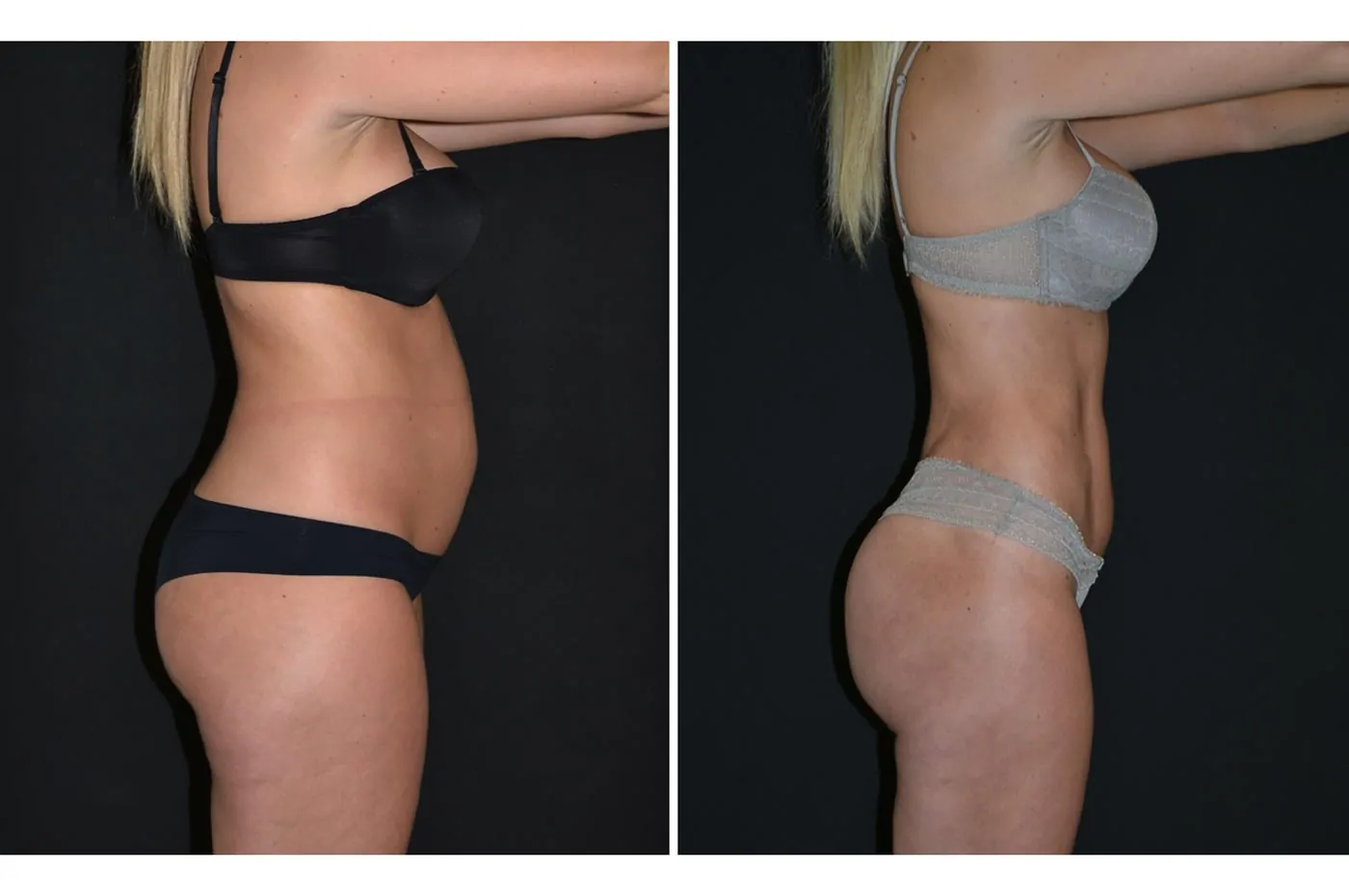 Female power assisted liposuction before (left) and after (right), side view
