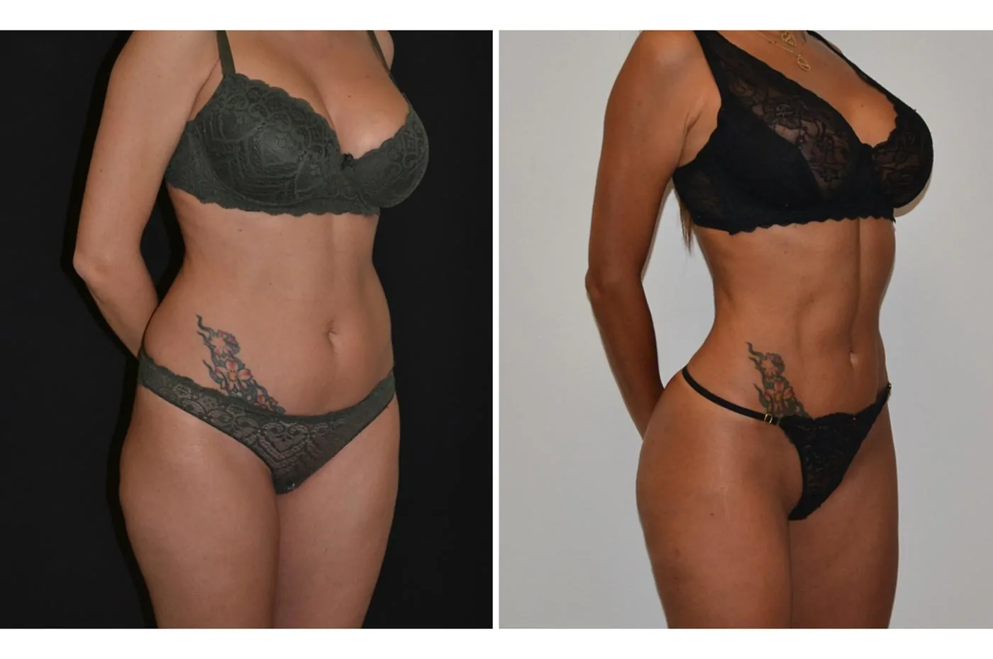 Female power assisted liposuction before (left) and after (right), side view