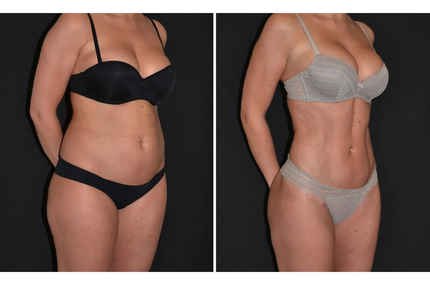 Female power assisted liposuction before (left) and after (right), side view