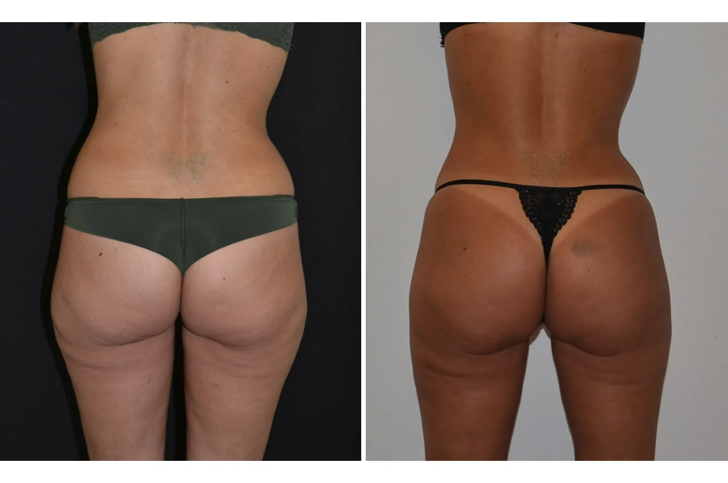 Female power assisted liposuction before (left) and after (right), back view