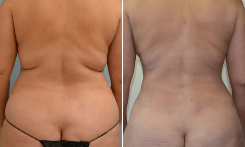 female liposuction before (left) and after (right), back view